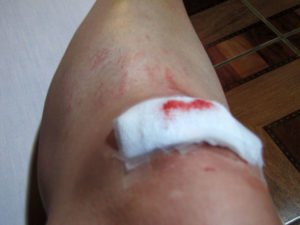 Wounds